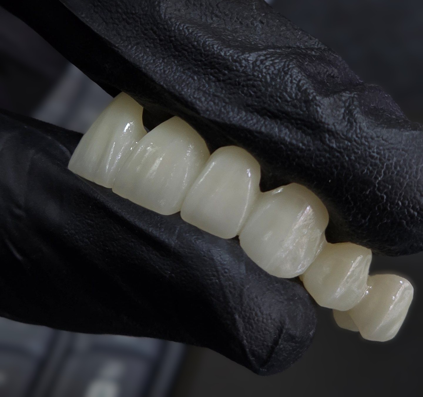 Monolithic Multilayer Zirconia vs Layered Zirconia: Clinical Decision Guide