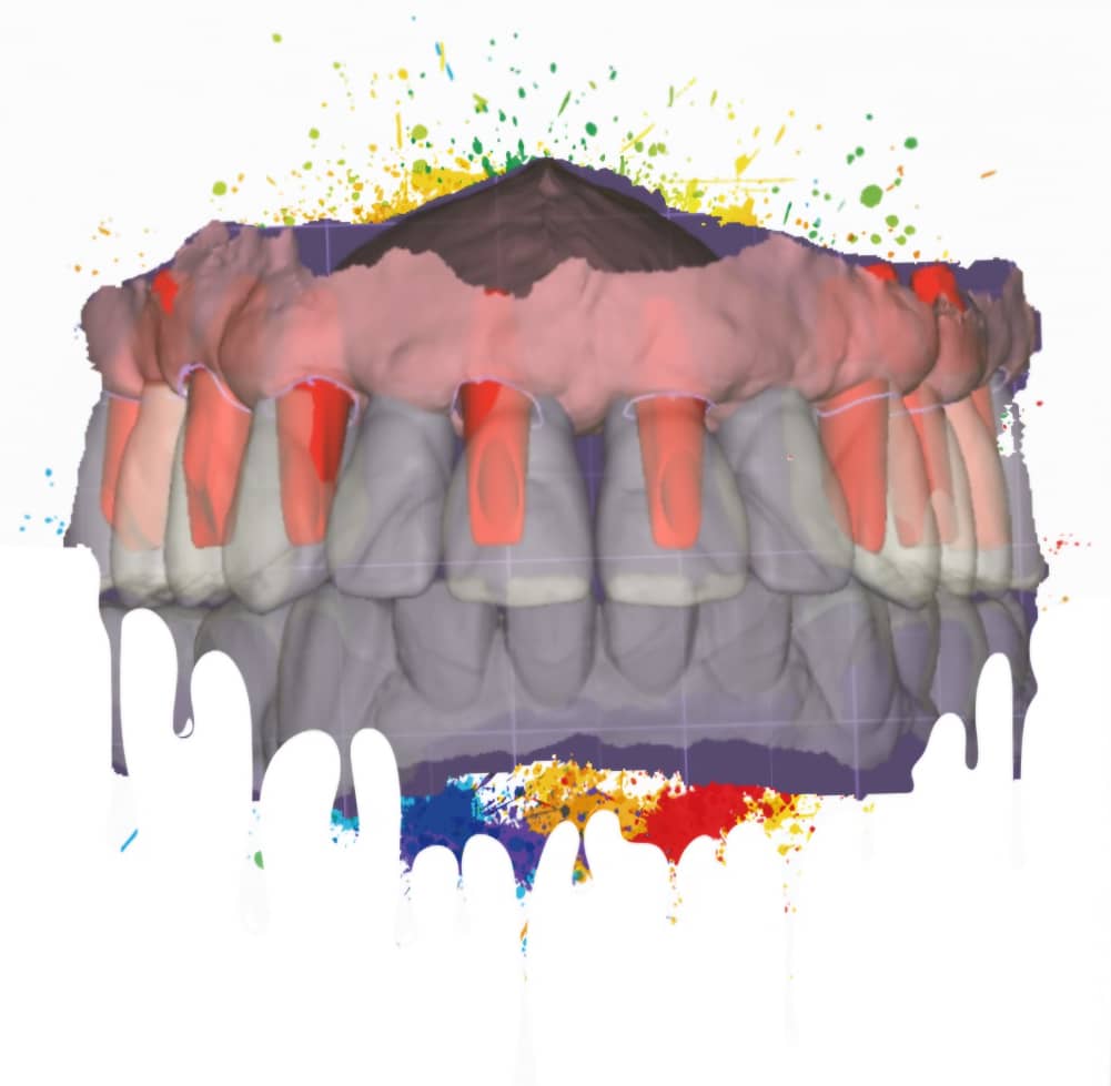 Full-Arch Implant Workflow with Custom Abutments